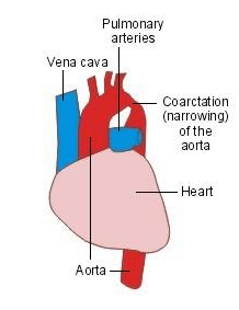 coarctation of aorta